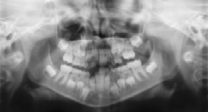 Dental Radiographs (X-Rays) - Pediatric Dentist in Silver Spring, MD