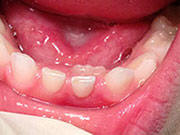 Baby Teeth - Pediatric Dentist in Silver Spring, MD